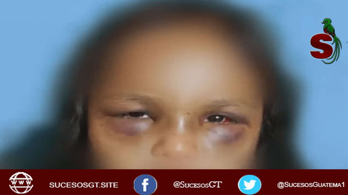 niña de 4 años brutalmente golpeada