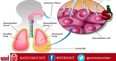 Imagen de mesotelioma, explica cómo afecta a los pulmones, se muestra una célula cancerígena, un pulmón sano y un pulmón dañado