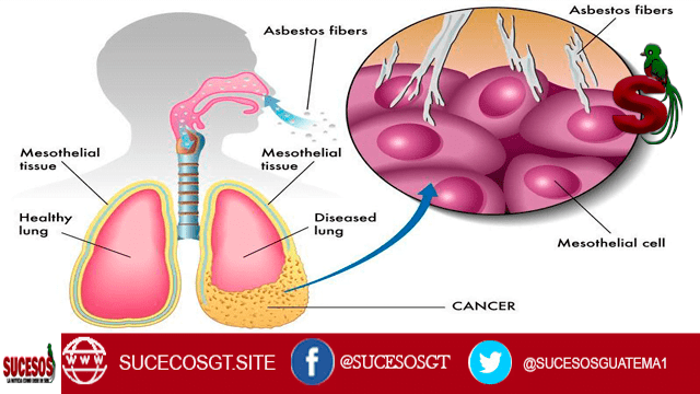Imagen de mesotelioma, explica cómo afecta a los pulmones, se muestra una célula cancerígena, un pulmón sano y un pulmón dañado