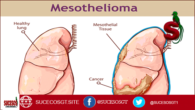 Mesothelioma El mesotelioma o como se escribe en inglés mesothelioma es un tipo de cáncer de la membrana que recubre los órganos y los tejidos. Esta enfermedad se desarrollar a partir de la exposición a la amianto, un material resistente al fuego que se ha utilizado en la construcción de hogares, durante muchos años.